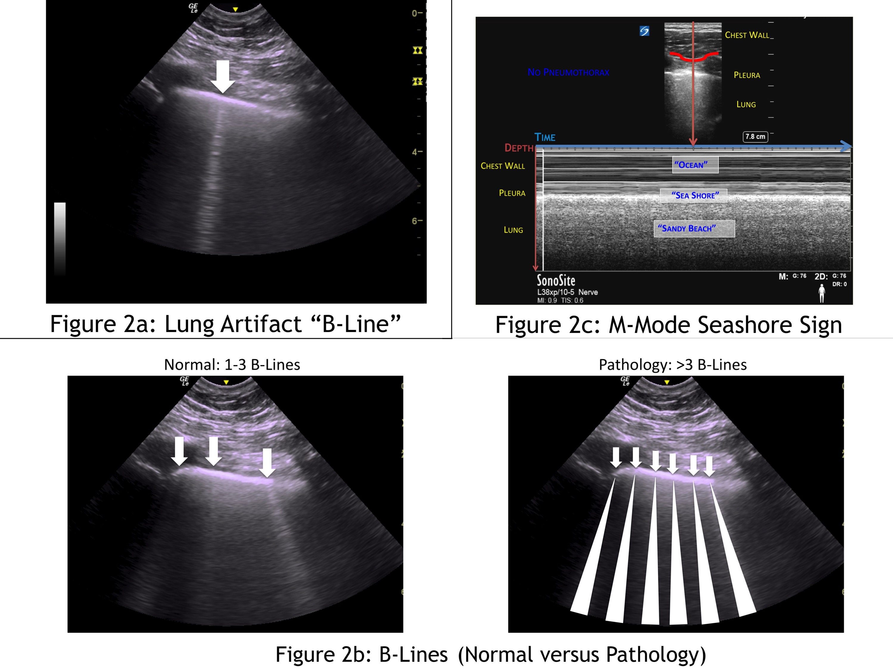 Lung Ultrasonography For The Regional Anesthesiologist