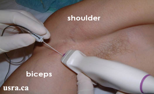 axillary-blockade-in-plane-approach-to-us-guided-axillary-block