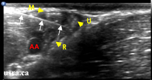 axillary-blockade-in-plane-view-of-a-needle-positioned