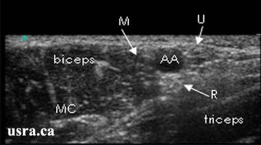 axillary-blockade-terminal-nerves-in-the-axilla