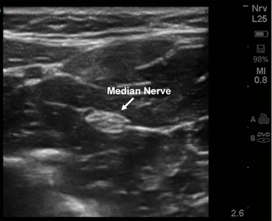 Ultrasound-Guided Peripheral Nerve Stimulation