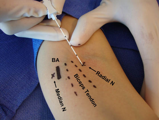 Peripheral Nerve Blocks of the Distal Upper Extremity