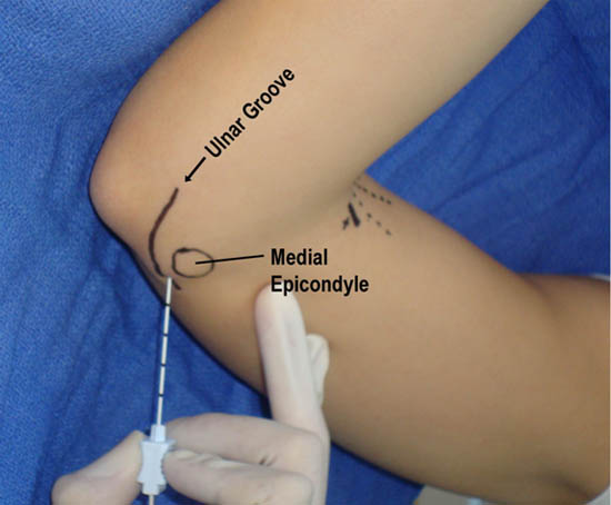 Peripheral Nerve Blocks of the Distal Upper Extremity