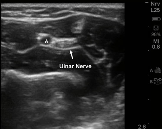 Ulnar Nerve Block Ultrasound