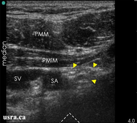 Sonoanatomy of the infraclavicular region with the transducer placed transverse below the clavicle