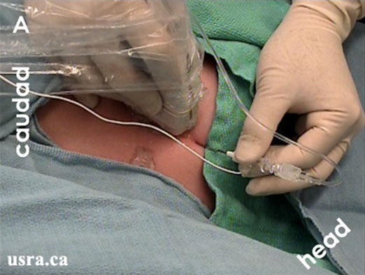In plane approach with stimulating Tuohy needle for continuous perineural catheter placement.