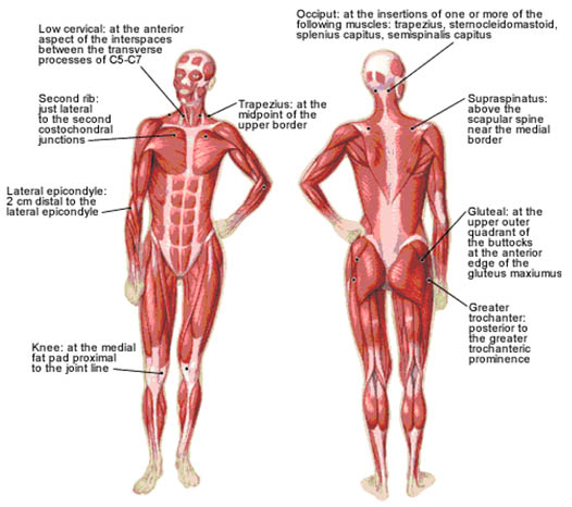 myofascial-pain-18-anatomically-defined-tender-points-in-fms