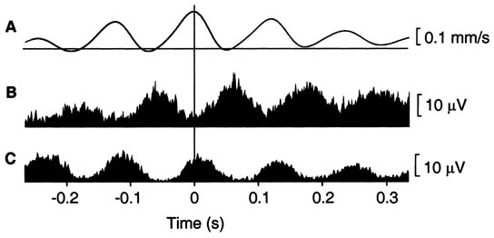 myofascial-pain-emg-of-myofascial-trigger-point