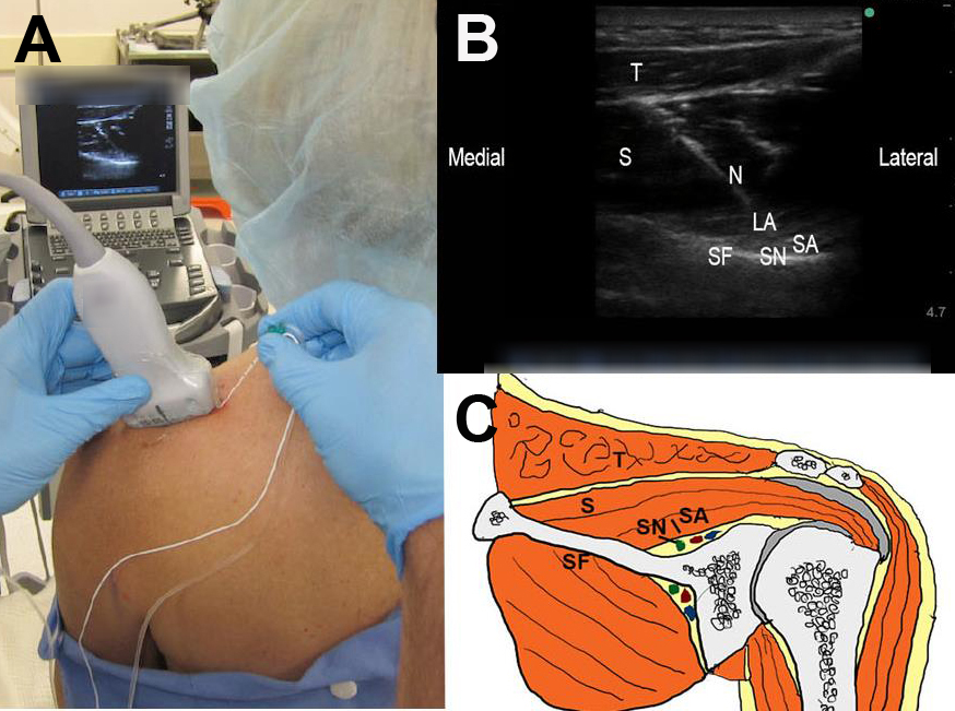 How I Do It: Ultrasound-Guided Combined Suprascapular And Axillary ...