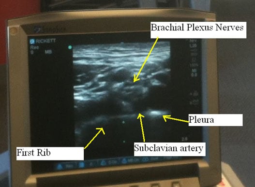 supraclavicular-block-brachial-plexus-and-neighboring-structures