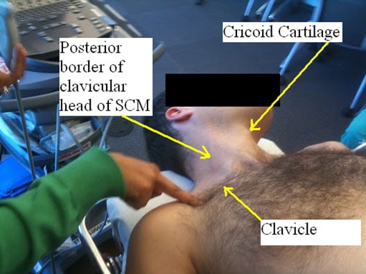 supraclavicular-block-surface-anatomical-landmarks