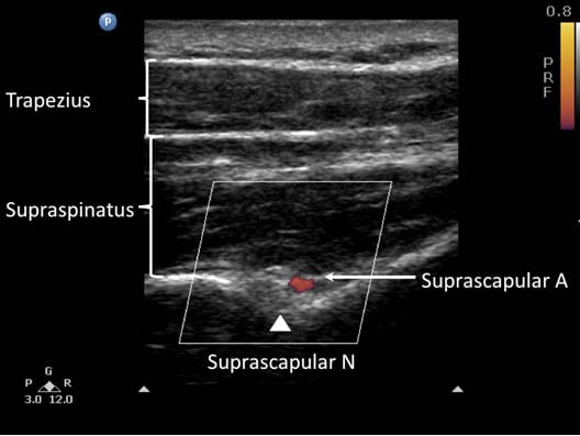 suprascapular-nerve-block-suprascapular-nerve