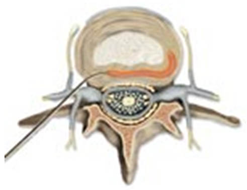 thermal-annular-procedures-disctrode