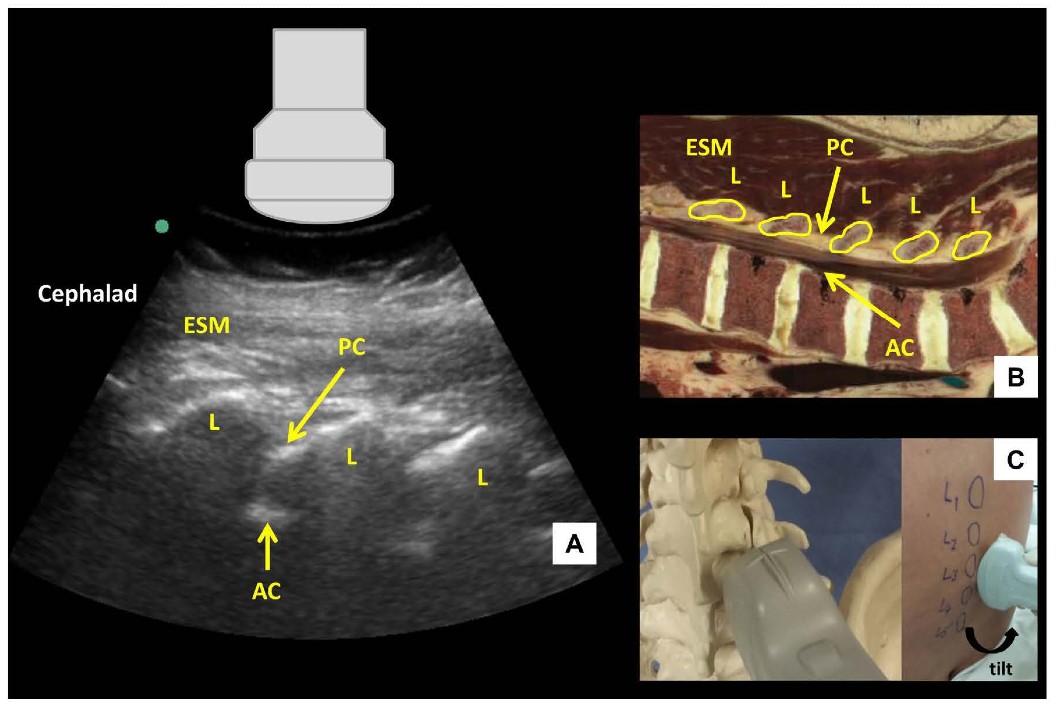 Ultrasound-Guided Lumbar Central Neuraxial Blockade