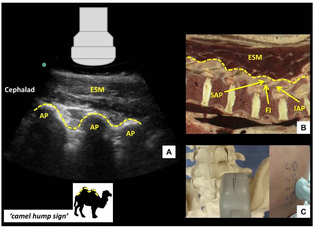 Ultrasound-Guided Lumbar Central Neuraxial Blockade