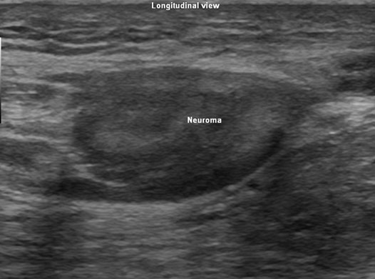 foot neuroma ultrasound