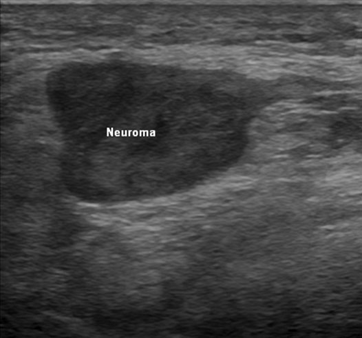 foot neuroma ultrasound