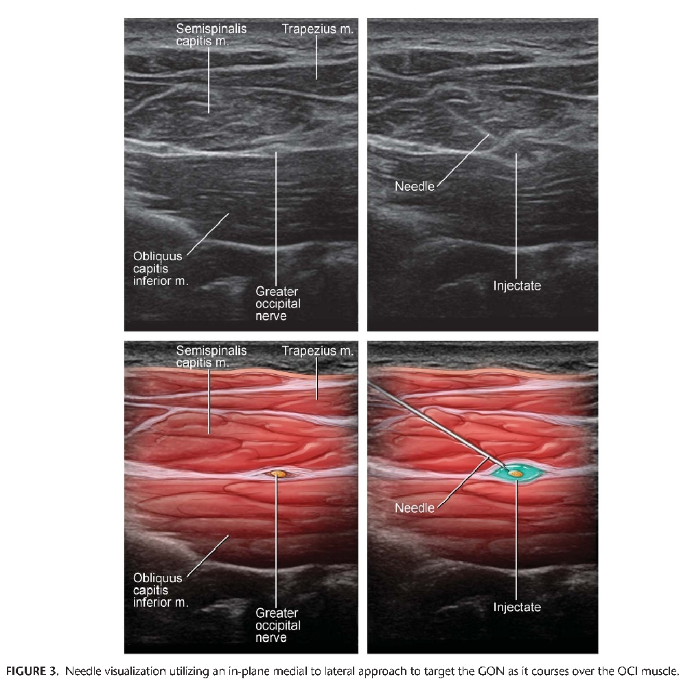 Overview Of Occipital Neuralgia And Greater Occipital Nerve Blocks 0738