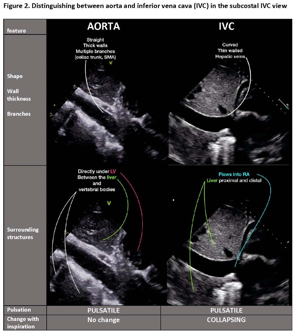 POCUS Spotlight: Focused Cardiac Ultrasonography