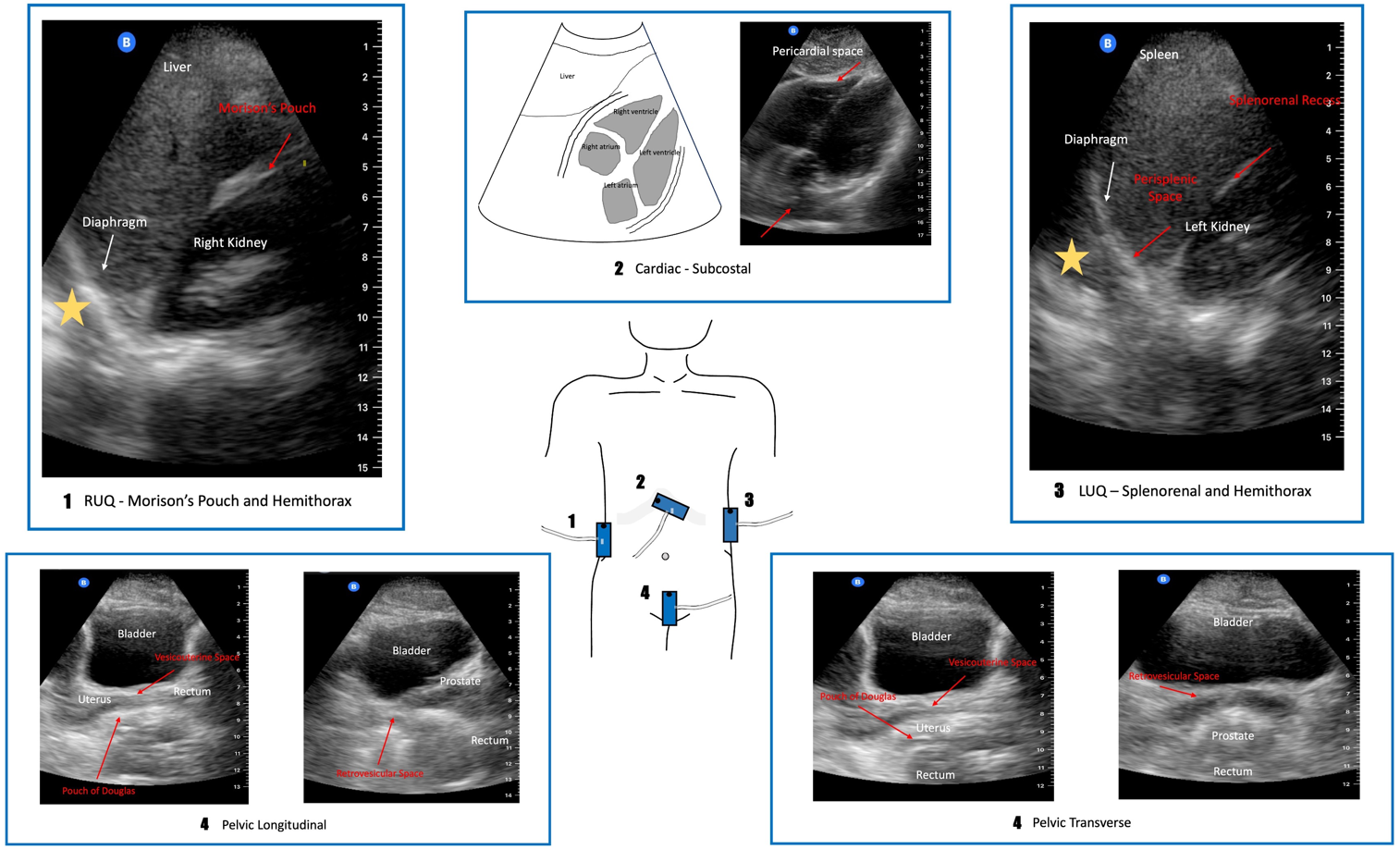 POCUS Spotlight: Focused Assessment With Sonography In Trauma (FAST) Exam