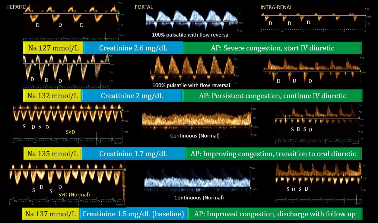 POCUS Spotlight: Venous Excess Ultrasound Score (VExUS)