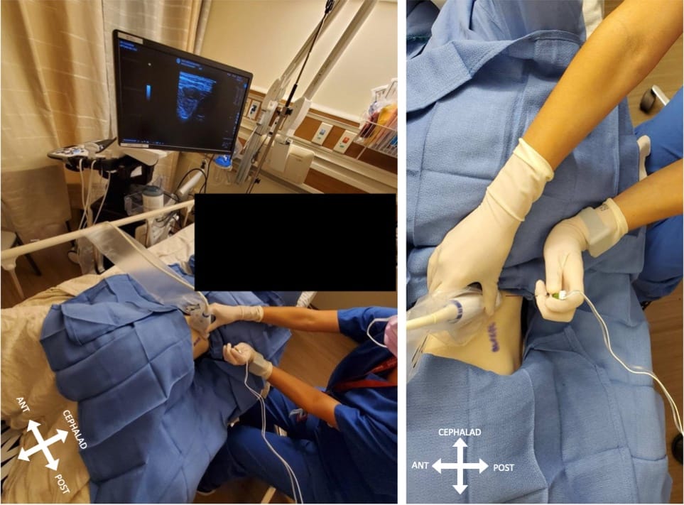 HIDI_Lumbar_Figure 1