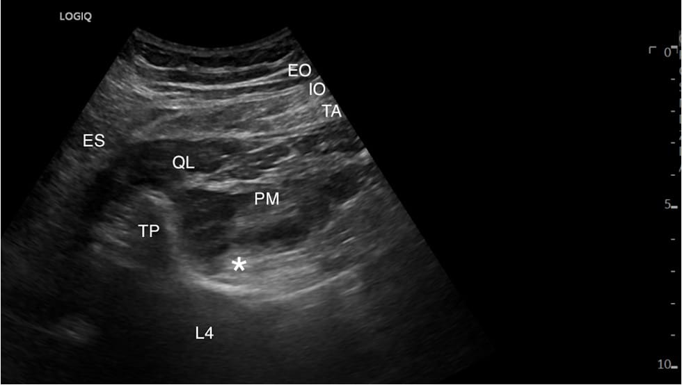 HIDI_Lumbar_Figure 2