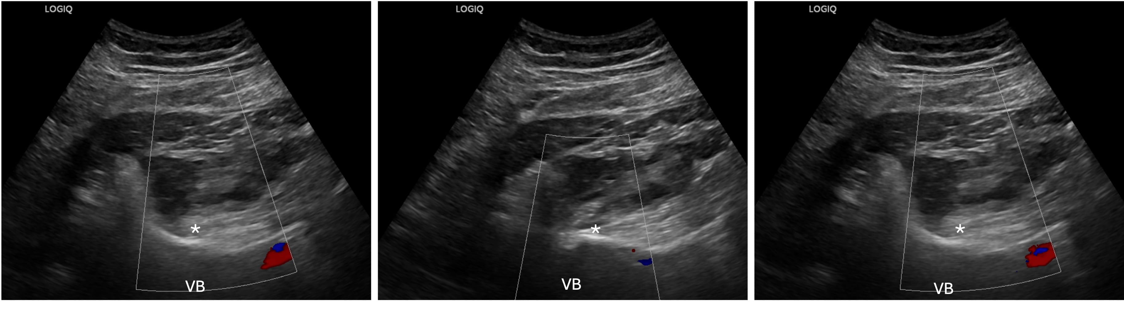 HIDI_Lumbar_Figure 3