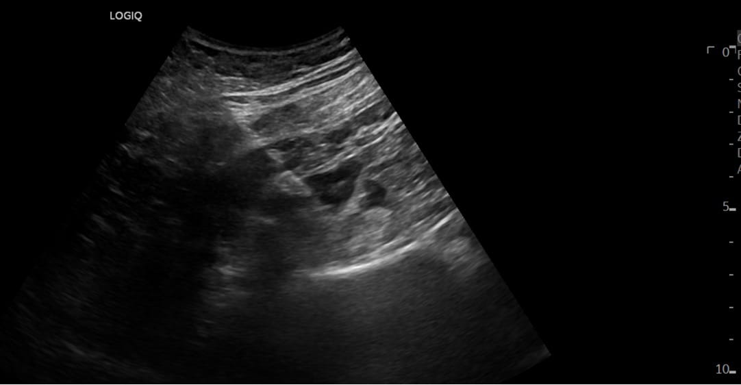 HIDI_Lumbar_Figure 4