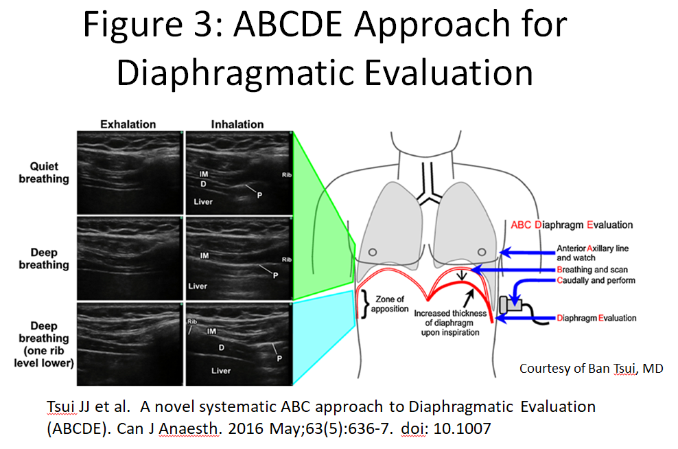 5_Diaphragm_Figure 3