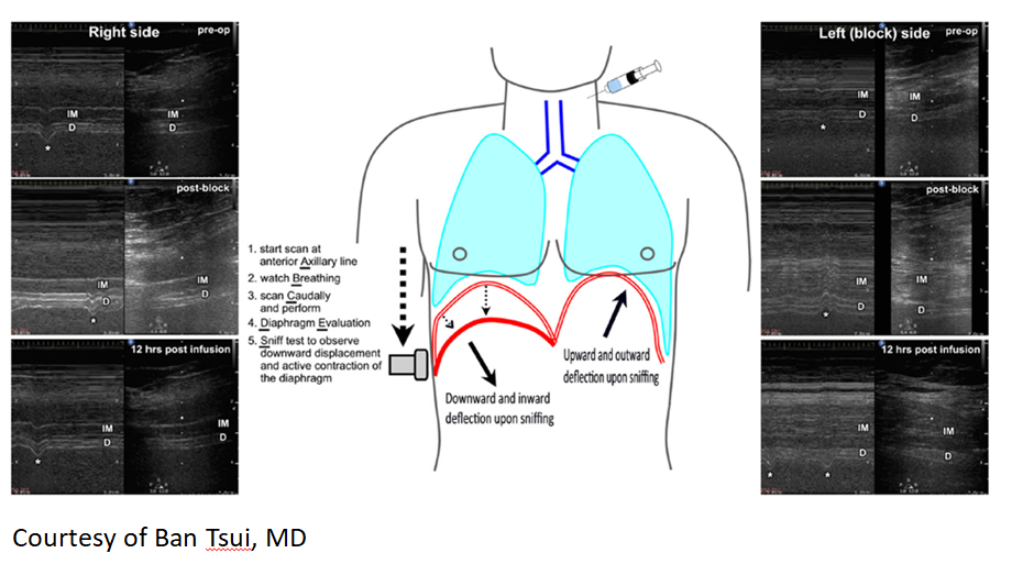 Diaphragm Ultrasonography For Regional Anesthesiologists