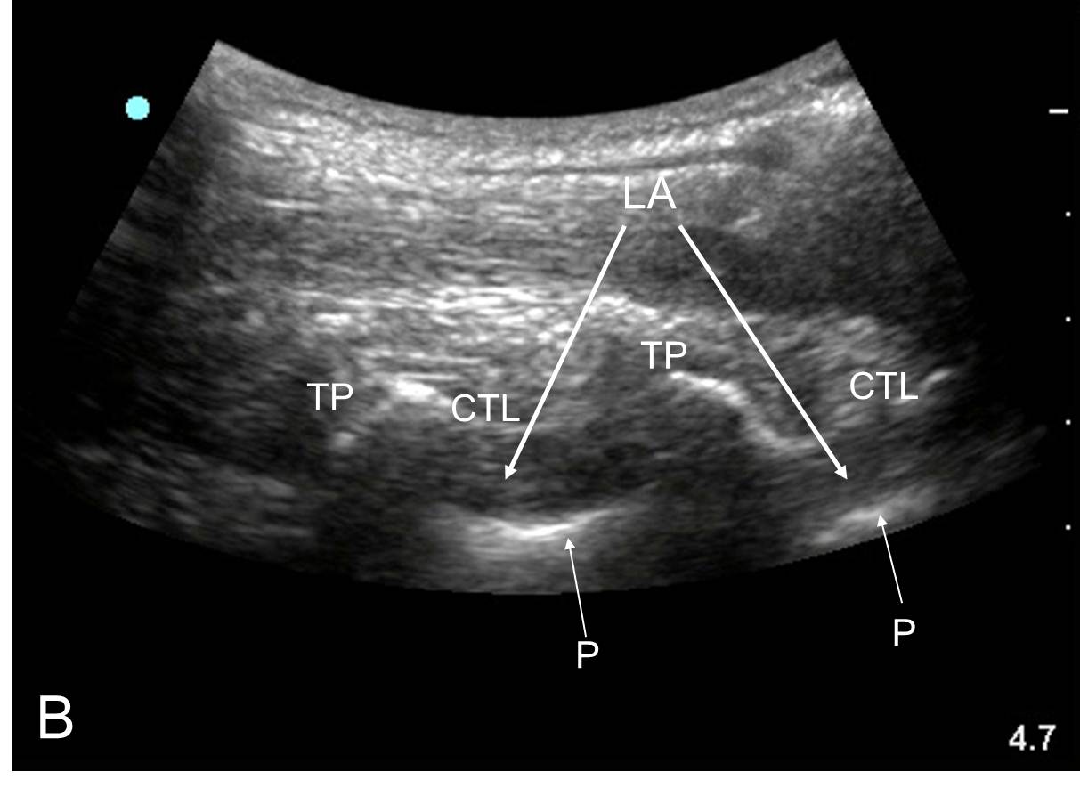 How We Do It: Ultrasound-Guided Thoracic Paravertebral Block, Feedback