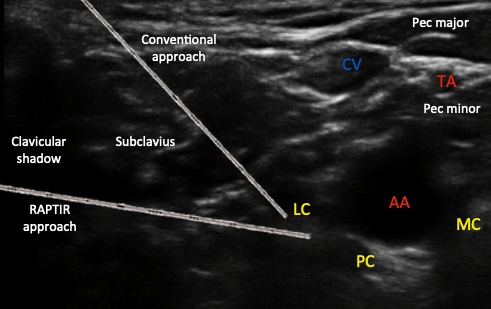 RAPTIR Block 5MS (2021) - Core Ultrasound