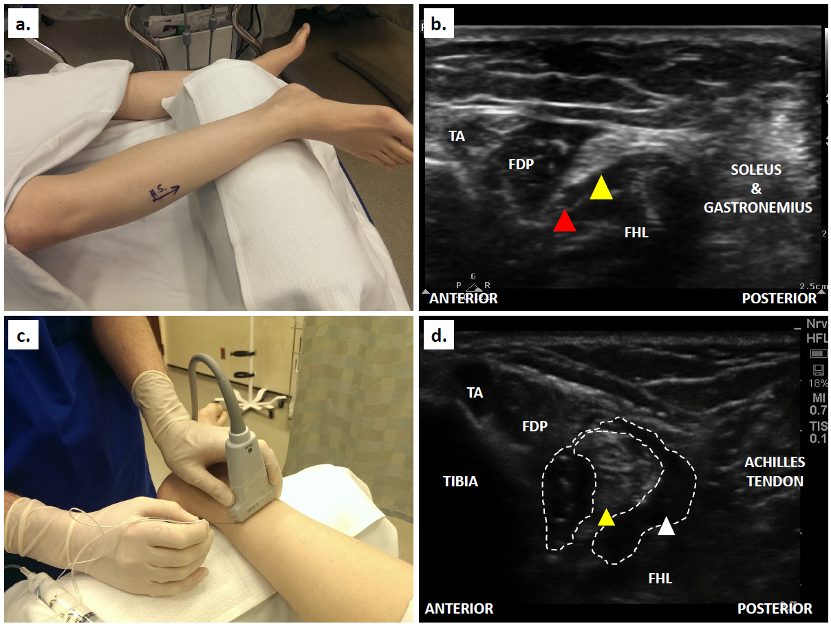 Superficial Peroneal Nerve Block