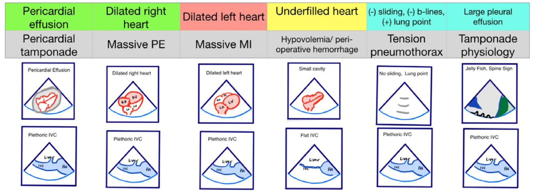 Pseudo-PEA phenotypes identified with EASy-ALS