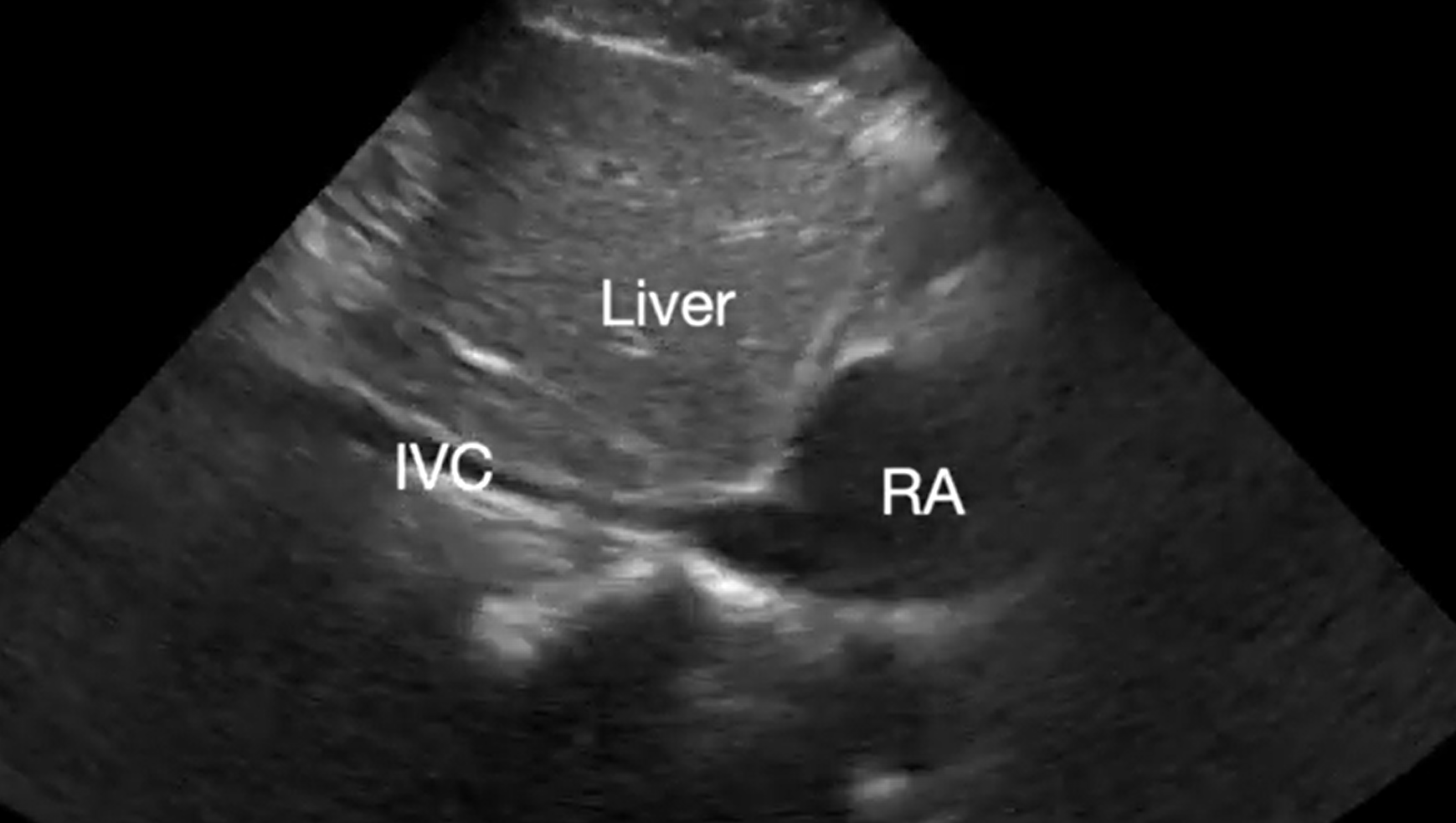 POCUS Spotlight: Point-of-Care Ultrasound In Cardiopulmonary Resuscitation