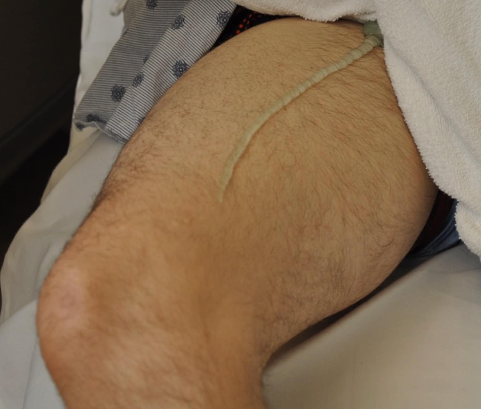 gastrocnemius vein dvt