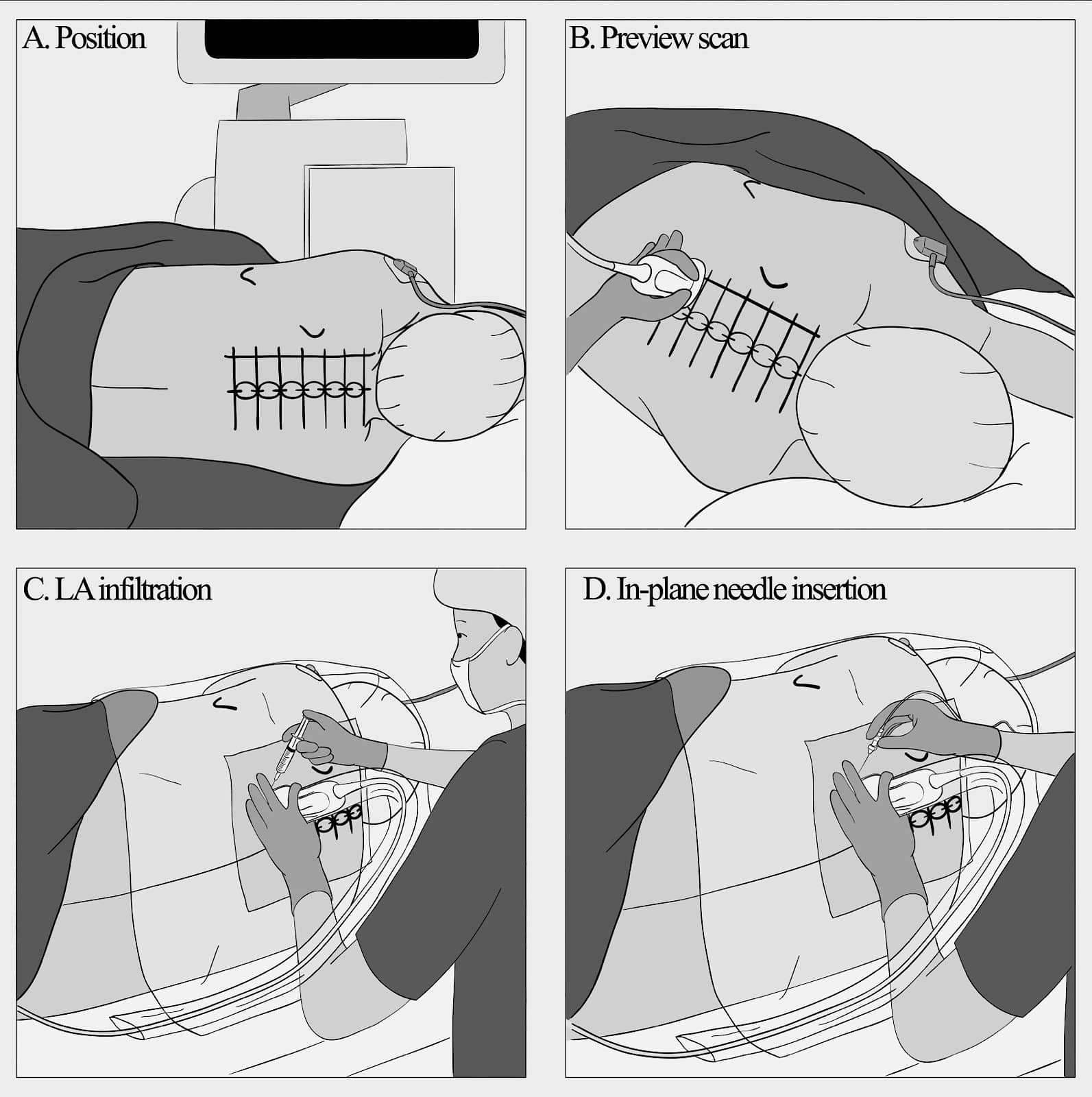 How I Do It: Ultrasound-Guided Thoracic Paravertebral Block