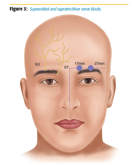 Figure 3. Supraorbital and supratrochlear nerve blocks