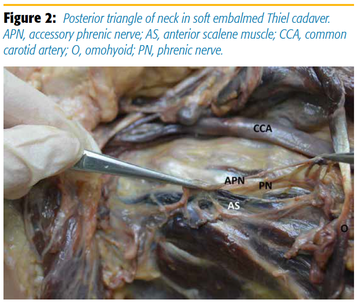 Figure 2 Posterior triangle of neck in soft embalmed Thiel cadaver