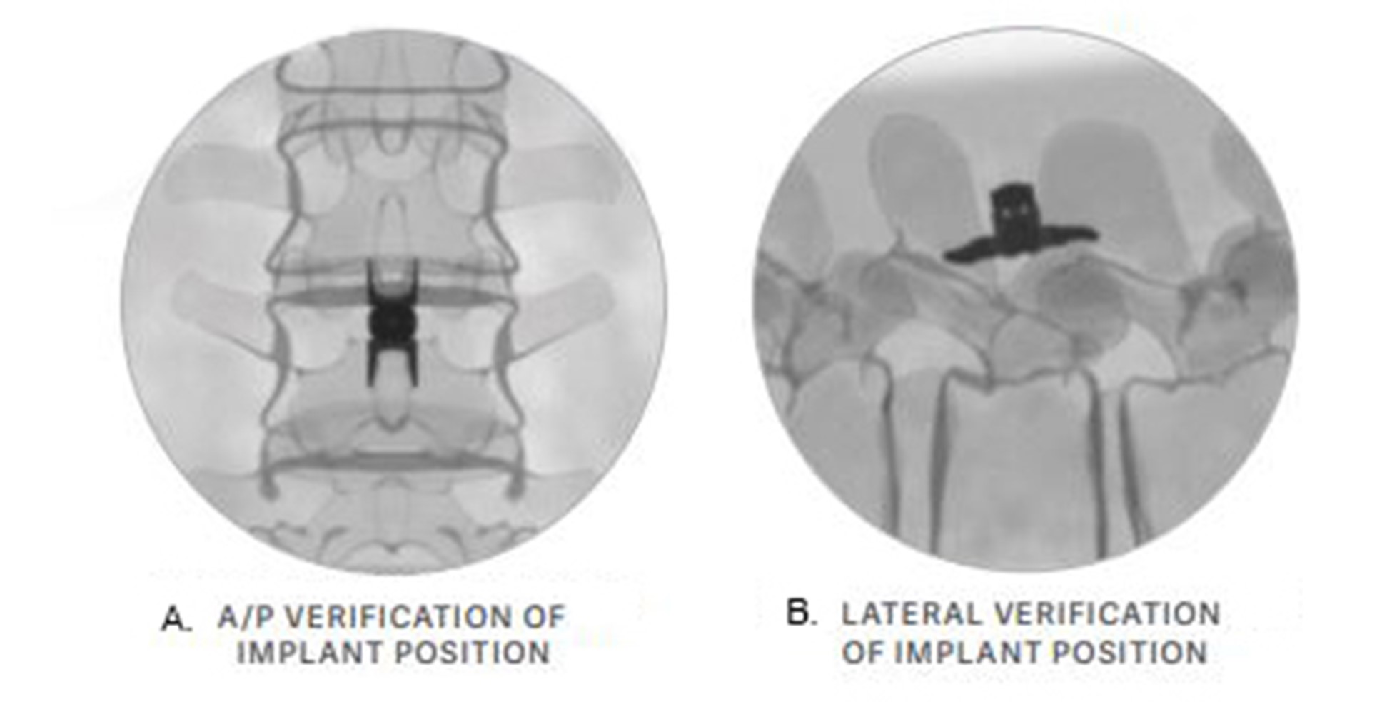 How I Do It: The Vertiflex® Procedure For Lumbar Spinal Stenosis