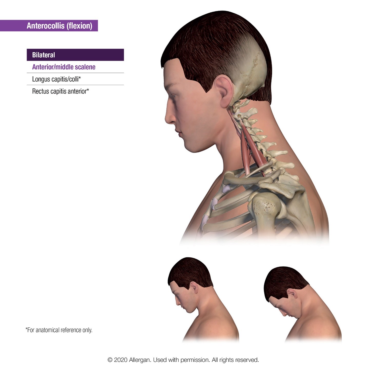 How I Do It: Botulinum Toxin For Cervical Dystonia