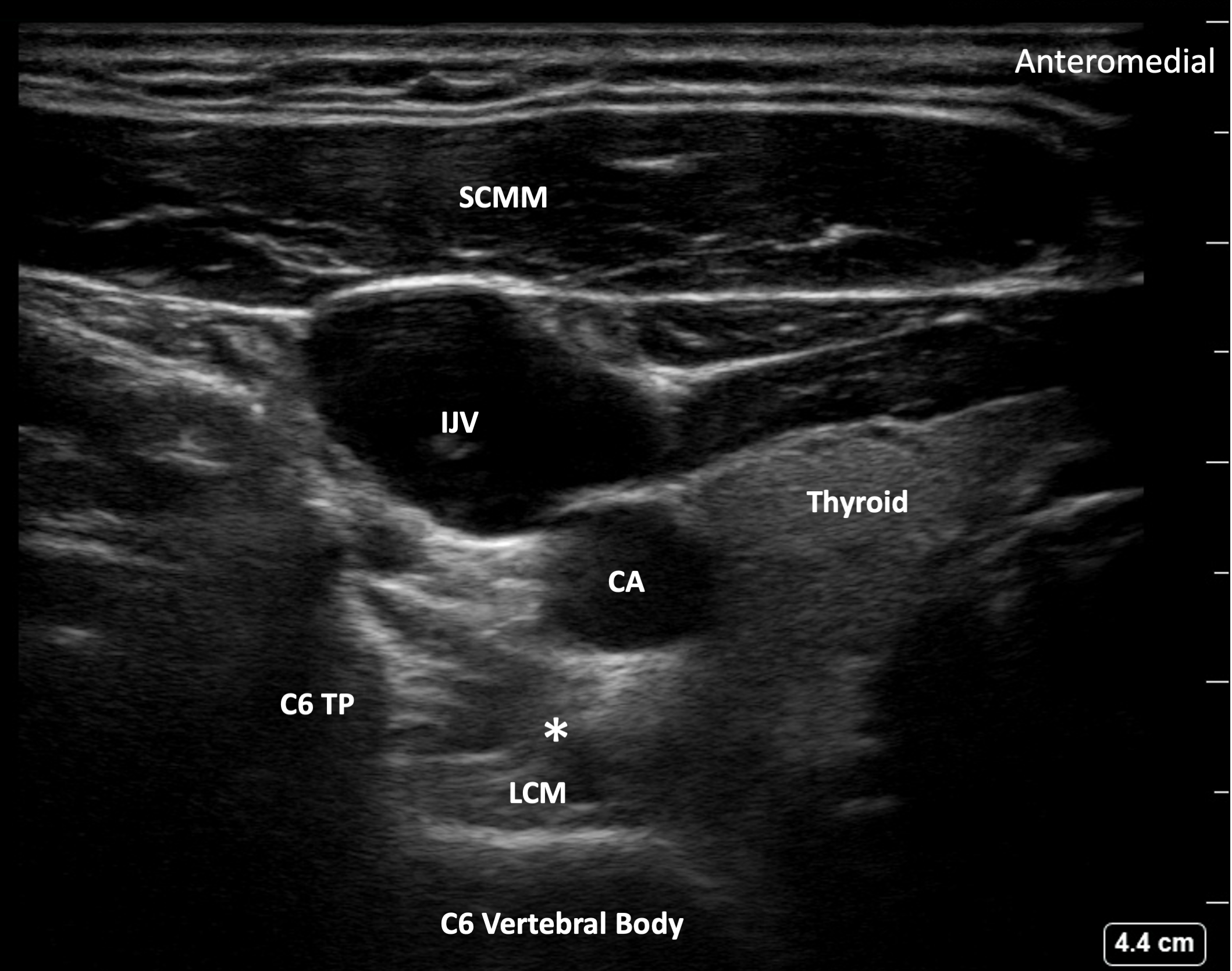 How I Do It: Stellate Ganglion Blocks For Refractory Ventricular ...